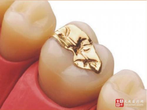 烤瓷57 产品类别 固定义齿 ---  烤瓷牙 制作周期