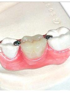 隐形义齿 -  隐形义齿  物品性质   (1)弹性卡臂因可以利用软组织